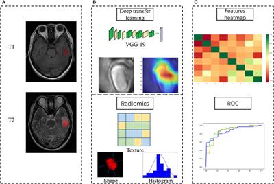 Differentiation of Brain Abscess From Cystic Glioma Using Conventional MRI Based on Deep Transfer Learning Features and Hand-Crafted Radiomics Features